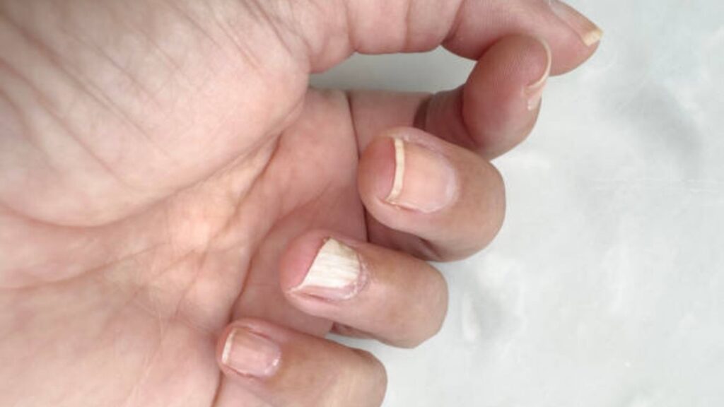 Bảo vệ móng tay bị gãy