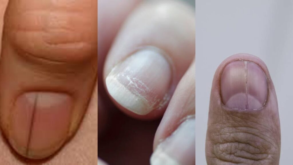 Các loại móng tay bị sọc thường gặp